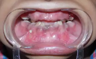 Intra-oral view showing severly attrited teeth, visible pulp chambers and class III anterior occlusal relationship.