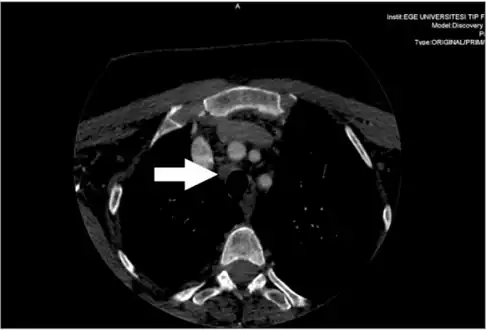 Metastatic central lymph node of a medullary thyroid cancer case