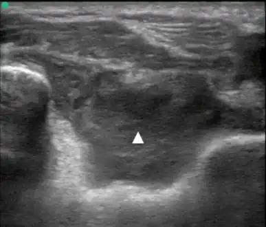 Posterior transverse view of the elbow with hemarthrosis