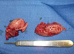 Cryptic tonsils immediately following surgical removal (bilateral tonsillectomy).