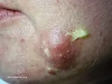 Discharge from the cyst with palpation