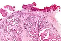 Micrograph of a papillary hidradenoma with the characteristic papillary structures and epithelium with apocrine snouts.  A fragmented overlying epidermis is seen at the top of the image. H&E stain.