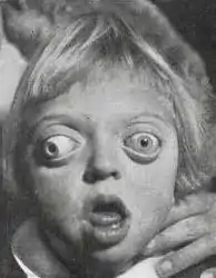 Child with Crouzon syndrome showing characteristic facial features.