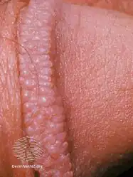 Pearly penile papules