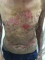 Pemphigus vulgaris