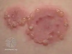 Pemphigoid gestationis