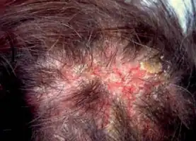 Pemphigus foliaceus scalp