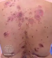 Pemphigus vulgaris