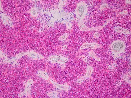 CD99 staining of tissue from peripheral PNET