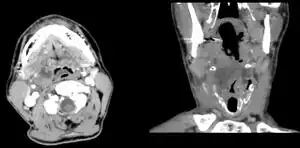 Peritonsillar abscess