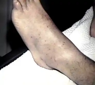 Petechiae on the lower extremities