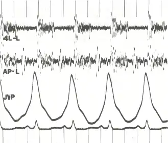 Phonocardiogram and jugular venous pulse tracing from a middle-aged man with pulmonary hypertension caused by cardiomyopathy. The jugular venous pulse tracing demonstrates a prominent a wave without a c or v wave being observed. The phonocardiograms (fourth left interspace and cardiac apex) show a murmur of tricuspid insufficiency and ventricular and atrial gallops.