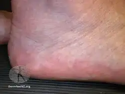 Piezogenic papules (heel)