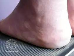 Piezogenic papules (heel)