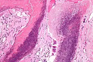 Micrograph of a pilomatricoma showing the characteristic "ghost" cells (anucleate squamous cells), benign viable squamous cells and multi-nucleated giant cells. H&E stain.