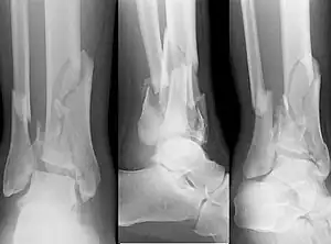 Pilon fracture.