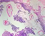 Pinworms are sometimes diagnosed incidentally by pathology. Micrograph of pinworms in the appendix, H&E stain