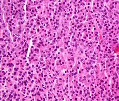 Micrograph of a plasmacytoma.