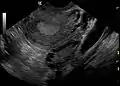 Transvaginal ultrasound scan of polycystic ovary