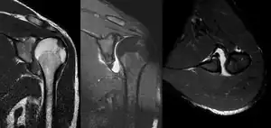 MRI of the shoulder after an anterior dislocation showing a Hill-Sachs lesion and labral Bankart lesion