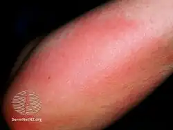 Pressure urticaria