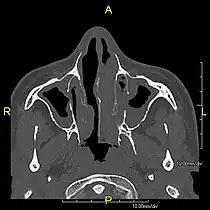 Axial CT image showing chronic sinusitis in an individual with Kartagener syndrome