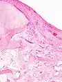 Histopathology of osteoarthrosis of a knee joint in an elderly female.