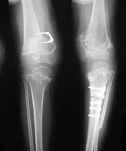 Pseudoachondroplasia. Leg radiographs depicting dysplastic distal femoral and proximal tibial epiphyses, and distal femoral metaphyseal broadening, cupping, irregularities (white arrows) and radiolucent areas especially medially. Note the metaphyseal line of ossification of the proximal tibias (blackarrows) and relative sparing of the tibial shafts. The  changes around the knee are known as "rachitic-like changes". Lesions are bilateral and symmetrical.