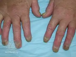 Psoriatic arthritis