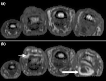 Magnetic resonance images of the fingers in psoriatic arthritis. Shown are T1 weighted axial (a) pre-contrast and (b) post-contrast images exhibiting dactylitis due to flexor tenosynovitis at the second finger with enhancement and thickening of the tendon sheath (large arrow). Synovitis is seen in the fourth proximal interphalangeal joint (small arrow).