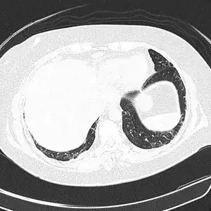 CT scan lungs: mass in right upper lobe