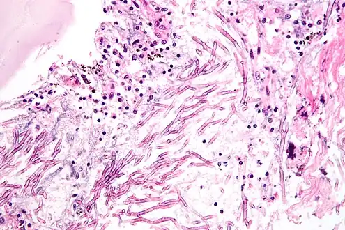 Pulmonary aspergillosis