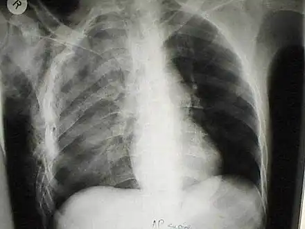 A chest X-ray of a right sided pulmonary contusion associated with flail chest and subcutaneous emphysema.  Contusion may mask pulmonary laceration on chest X-ray.