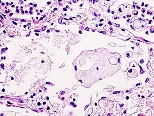 H&E stain: histiocytic penumonia