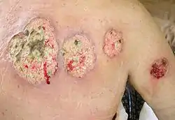 Pyoderma gangrenosum