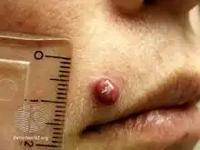 Pyogenic granuloma