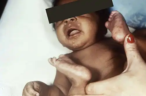 Rash of congenital syphilis