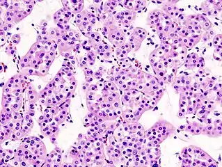 Micrograph of a renal oncocytoma. H&E stain.