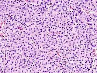 Micrograph of a renal oncocytoma. H&E stain.