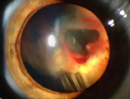 Slit lamp photograph showing retinal detachment in Von Hippel–Lindau disease