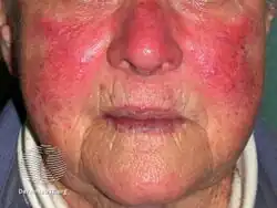 Rosacea