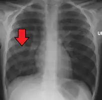 Right middle lobe pneumonia in a child as seen on plain X ray