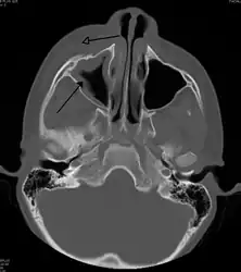 Periorbital cellulitis caused by a dental infection (also causing maxillary sinusitis)