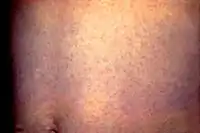 Generalized rash on the abdomen due to rubella