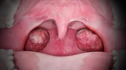 A medical animation still that shows Tonsillitis.