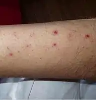 Numerous spots of bleeding into the skin of the leg in a person infected with T. b. rhodesiense