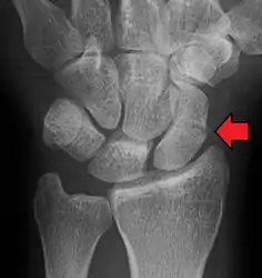 A subtle scaphoid fracture