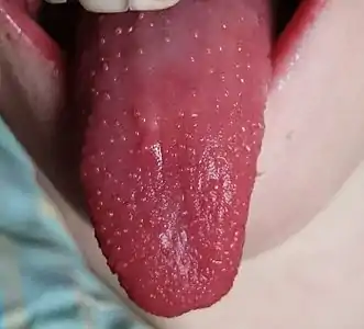 Complete shedding of white coating: red strawberry tongue