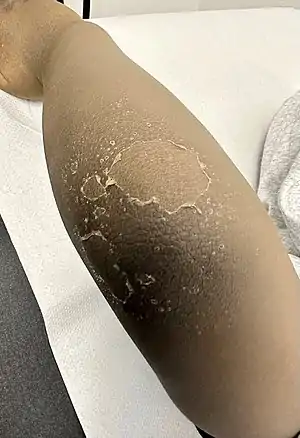 Skin peeling at elbow