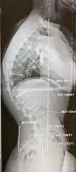 Scheuermann's disease, showing various measurement of kyphotic/lordotic degrees and their supplementary angles. Notice the signature 'wedging' shape of the four vertebrae in the lower thoracic area. The other vertebral bodies are otherwise normal.